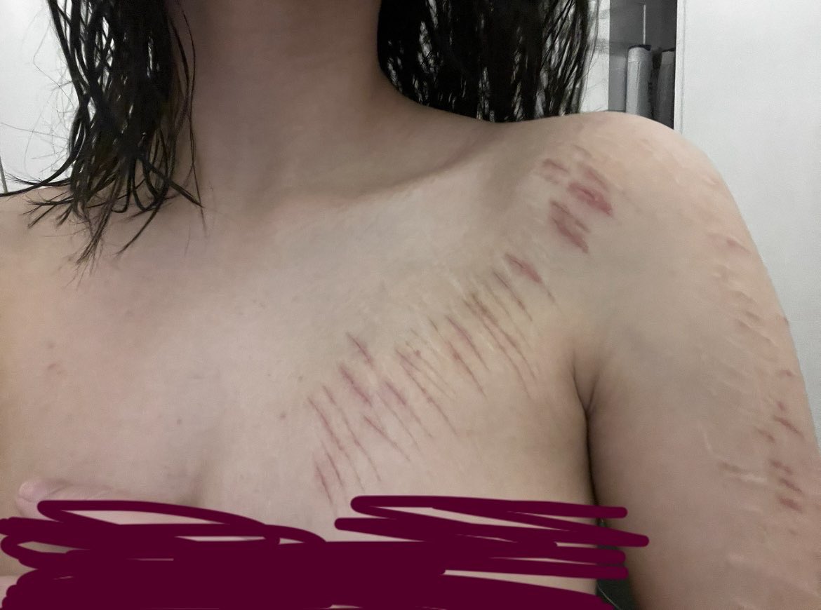 skllouds2's tweet photo. I’m so fat and these scars hurt so bad ok all fake special effects makeup sigh #shedrtwt #notreal https://t.co/xTs5FKBKOS