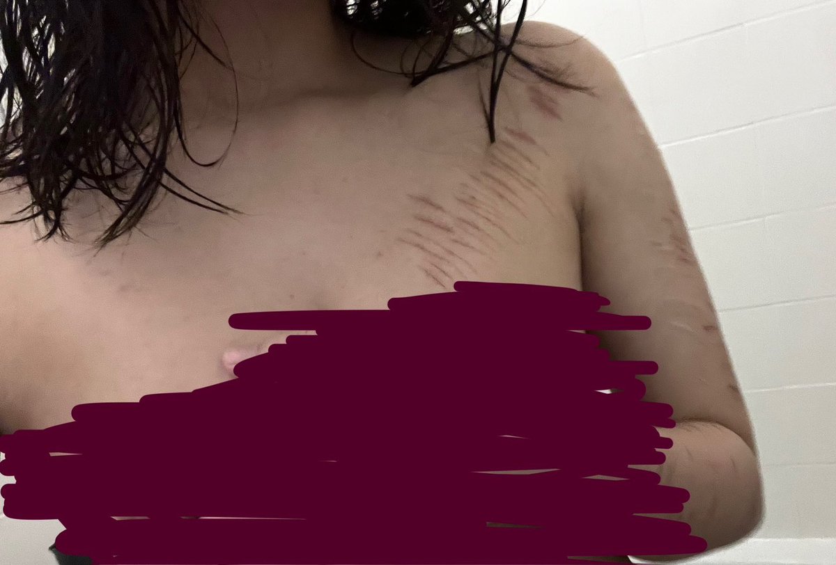 skllouds2's tweet photo. I’m so fat and these scars hurt so bad ok all fake special effects makeup sigh #shedrtwt #notreal https://t.co/xTs5FKBKOS