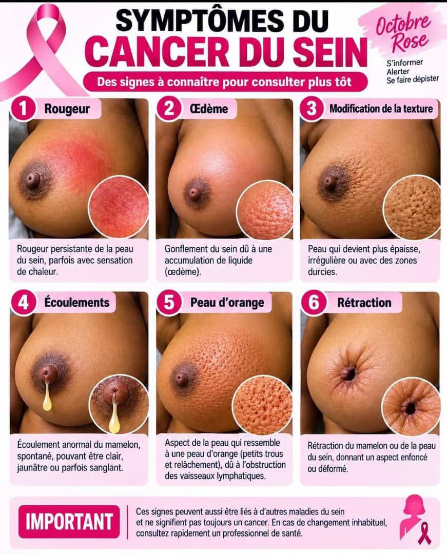 GrandtCardone's tweet photo. 6 signes d’alerte sur le cancer du sein. Ils doivent vous emmener à consulter un professionnel de santé pour plus d'investigation.

1. Rougeur du sein : une rougeur persistante de la peau, parfois accompagnée d’une sensation de chaleur.

2. Œdème : un gonflement inhabituel du… https://t.co/zbCRmuK232