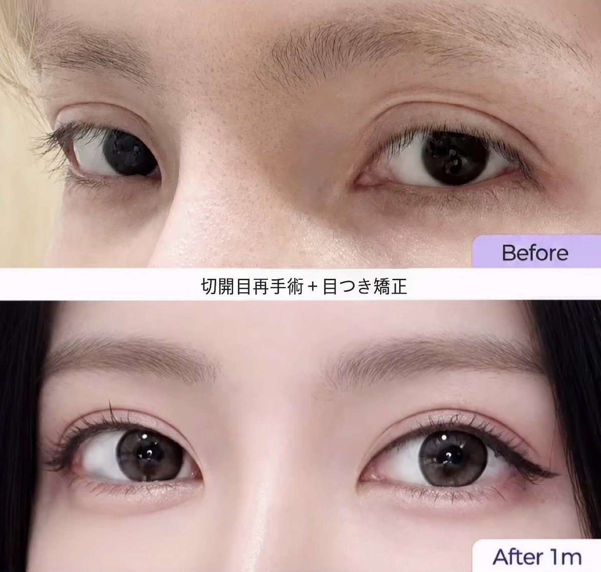 icontactjpps's tweet photo. 目再手術の症例写真👁✨
二重切開再手術＋目つき矯正

二重幅が広くハム目のように見える目元から自分の目元に合う二重ラインへを作り直すことでパッチリとした目元へと🖤

#目専門 #アイコンタクト整形外科 
#自然癒着 #目再手術 #ハム目 https://t.co/KfvYU9rwkn