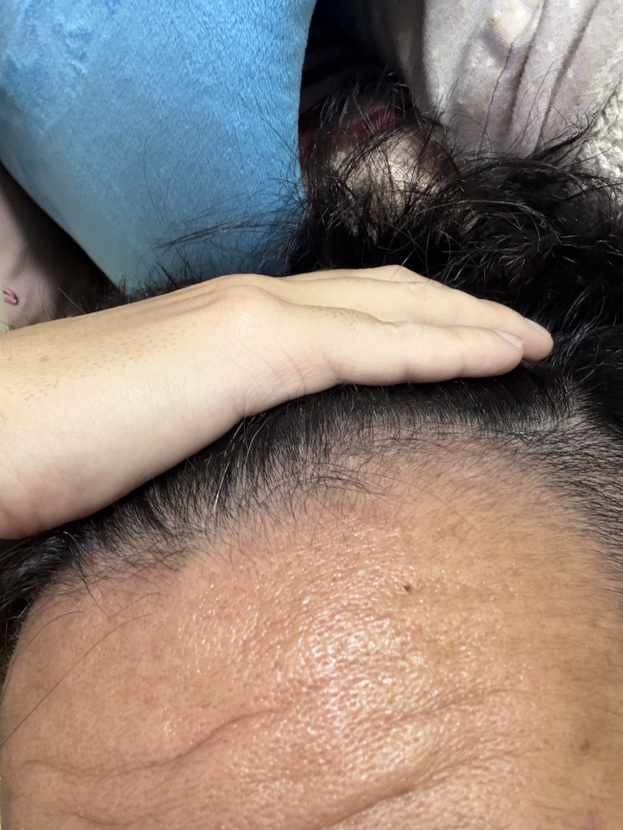 yaruo_s's tweet photo. 10/4 991日目経過観察。
真ん中、左、右の画像。ミノキシジル5mg→10mg。特に変化なし。#AGA #ハゲ #生えてきた https://t.co/tQtXGOJBwS