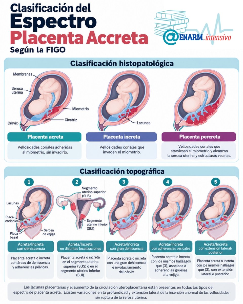 ENARM_intensivo's tweet photo. 💢CLASIFICACIÓN DEL ESPECTRO PLACENTA ACCRETA
#ENARM_INTENSIVO #ESTUDIA_MEDICINA https://t.co/qFmKa1c1sE