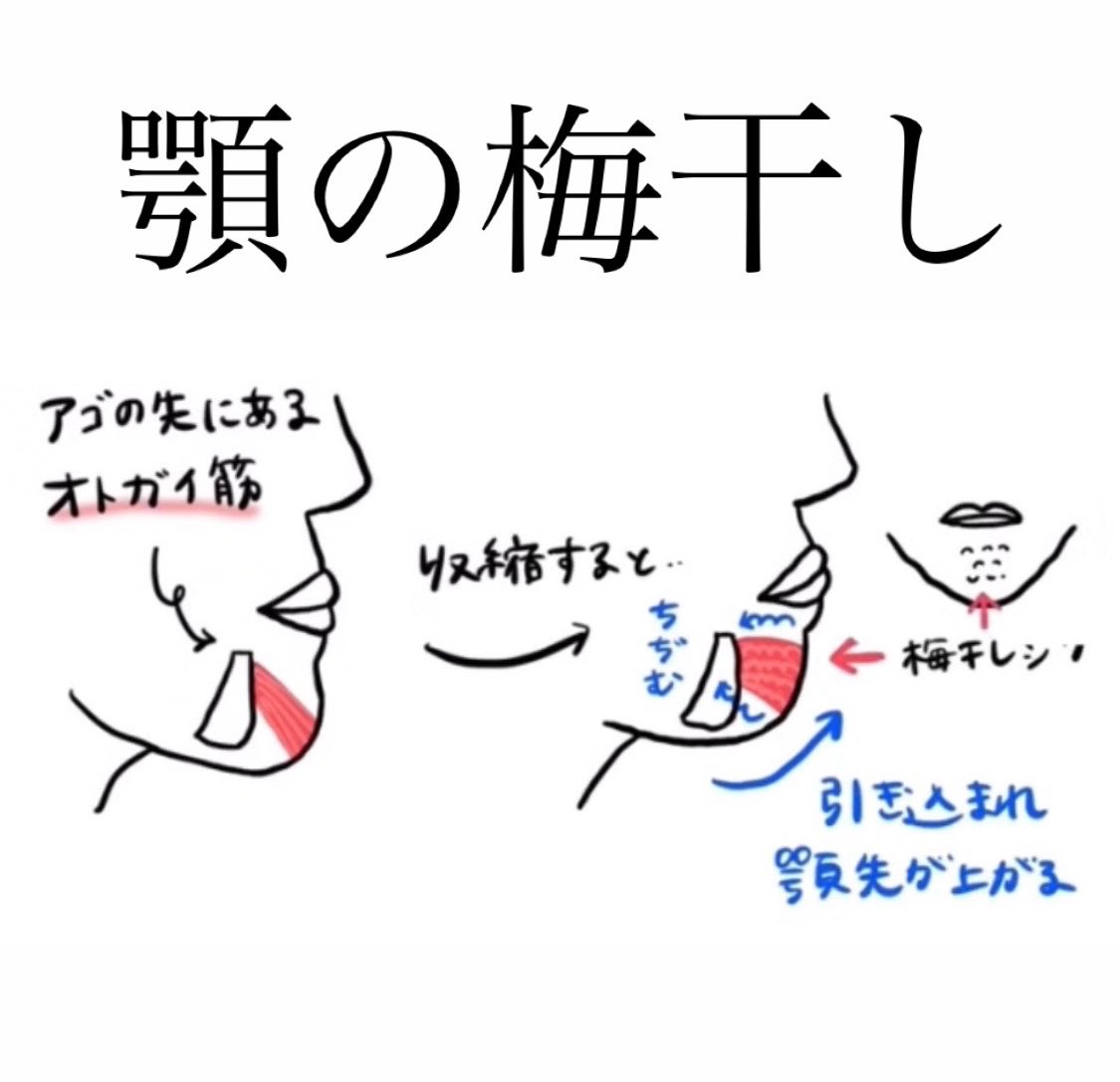 3b2zg's tweet photo. 日プ時代の神楽と比べると顎の梅干しが無くなっている。

抜歯矯正やオトガイ形成をして口ゴボが緩和すると、口を閉じる際にオトガイ筋の緊張と収縮がなくなるので、顎が疲れにくくなるし梅干しも消える。

両顎手術や抜歯矯正で顎骨が後ろに引っ込��と顔が事故りにくく他撮りで盛れるのはこれが理由。 https://t.co/Hf2EKROEfq