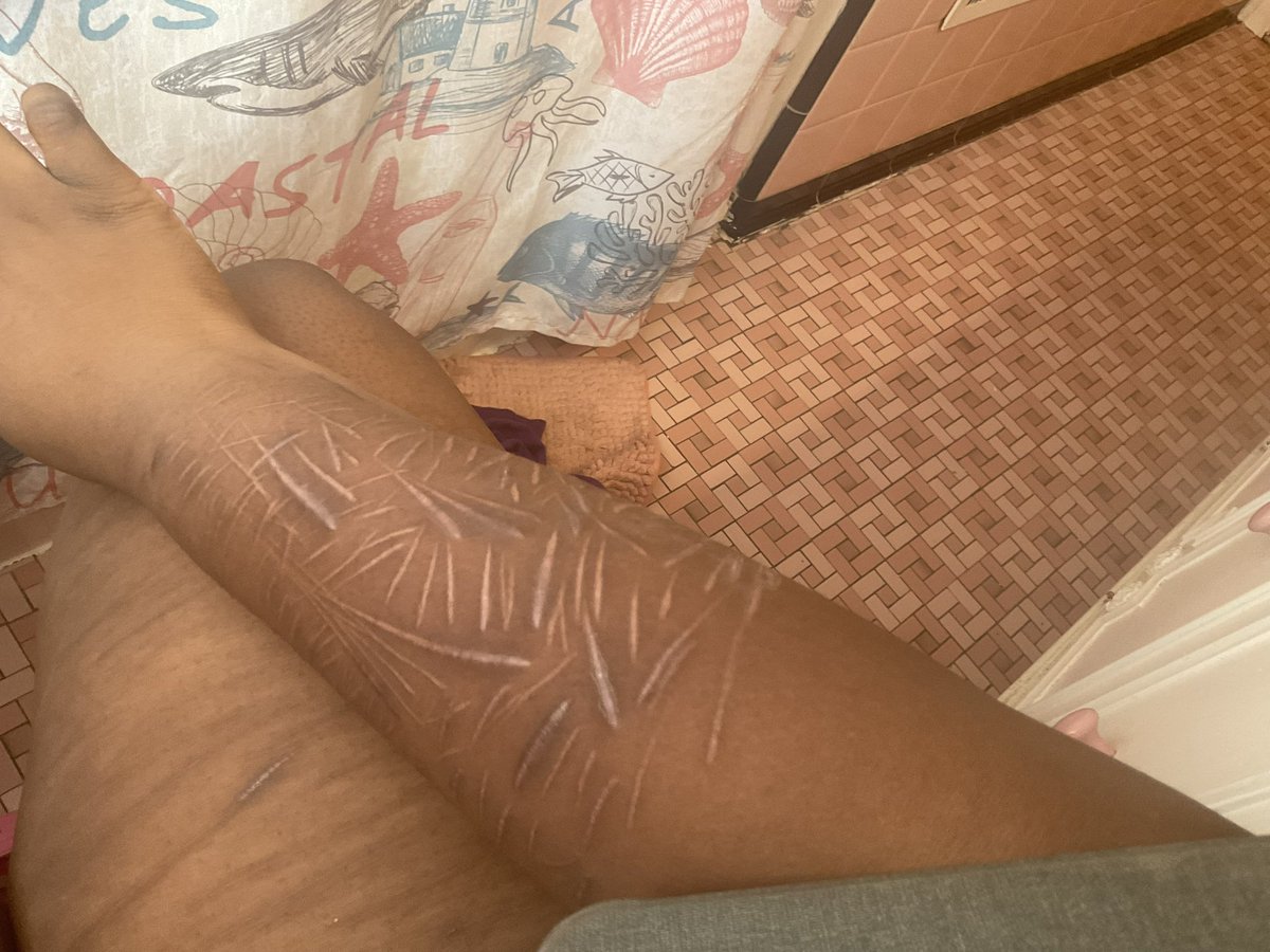 SweetPupyDreams's tweet photo. #healing so far https://t.co/CwI3lvcAPI