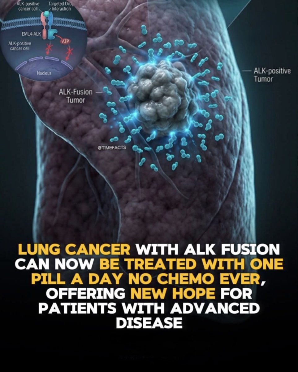 NextScience's tweet photo. 🫁 One genetic test can completely change how some lung cancers are treated

Imagine being diagnosed with lung cancer… and discovering that chemotherapy may not be the first treatment you need.

For about 4%–5% of non-small cell lung cancers (NSCLC), the tumor carries an ALK gene rearrangement. This genetic change can act like a switch that keeps cancer cells growing.

But here’s where things get interesting.
Doctors can use targeted pills called ALK inhibitors to block that cancer-driving signal. One established option is alectinib (Alecensa), which can be used as a treatment without chemotherapy in appropriate patients with ALK-positive advanced NSCLC.

And there’s another reason researchers pay close attention to this drug: the brain. In a major clinical trial, people receiving alectinib had much less cancer progression in the brain than those receiving crizotinib.
The story doesn’t stop there.

Alectinib is also approved after surgery for certain patients with ALK-positive NSCLC. In the ALINA trial, it significantly improved disease-free survival compared with platinum-based chemotherapy.

So a tiny piece of genetic information from a tumor can sometimes change the entire treatment path — from traditional chemotherapy to a drug designed specifically to target the cancer’s molecular weakness.

The future of cancer treatment may not be one treatment for everyone. It may be the right treatment for the exact biology of each tumor.

Source: National Cancer Institute. (n.d.). Non-small cell lung cancer treatment; ALK-positive lung cancer and targeted therapy. U.S. National Institutes of Health.