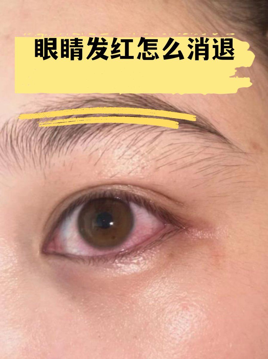 TrinityHattead's tweet photo. El cantante Cheng Lei se enoja y mira con ira mientras la inflamación se alivia lentamente， https://t.co/kCDIA7Zzpk