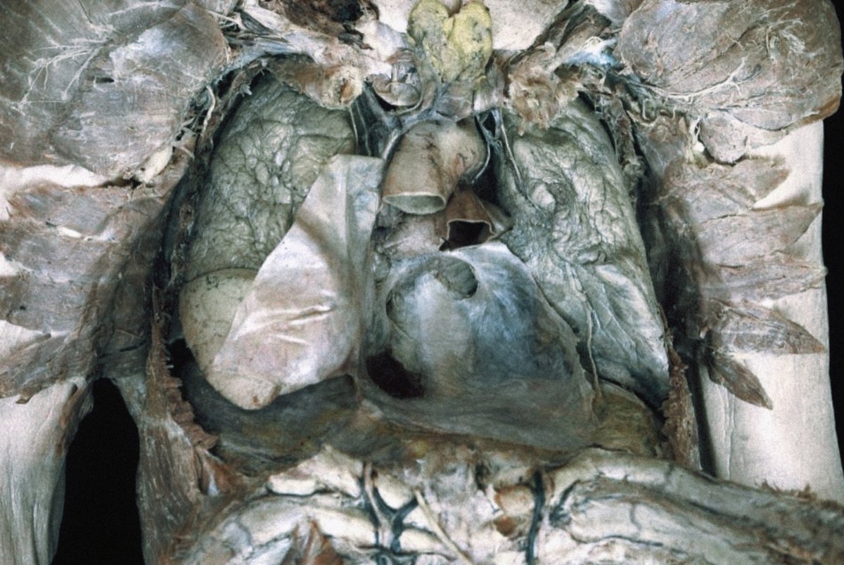 moriitician's tweet photo. thoracic cavity, heart removed. •˚꩜｡ https://t.co/khRuDTav0b