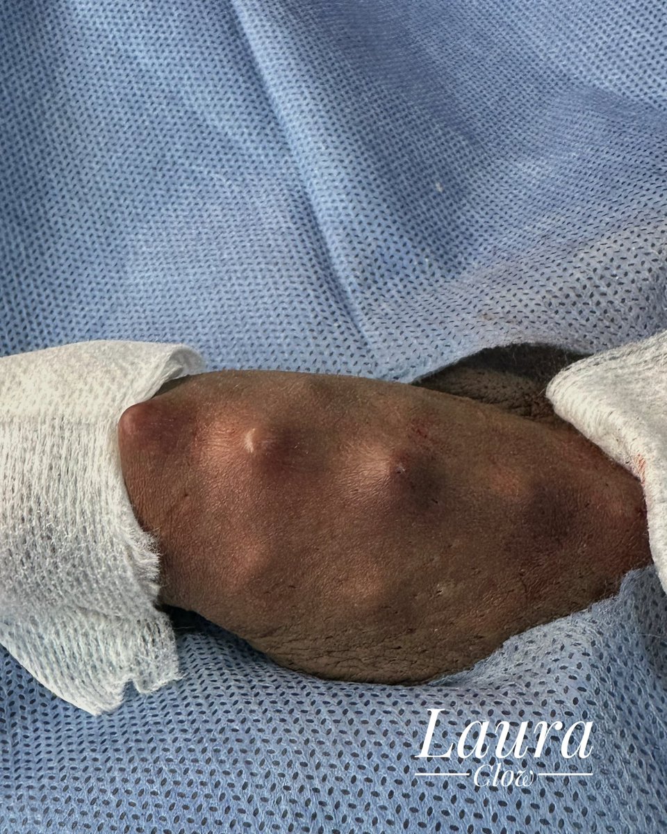 LauraClow14's tweet photo. Pearling | Genital Beading ✨
Implantes subdérmicos de silicona grado implante o pirex, colocados de forma personalizada según tu anatomía.
📍 Puebla
📩 Cotiza por mensaje privado
#Pearling #GenitalBeading #BodyModification #Puebla https://t.co/Ys7pAkuPCP