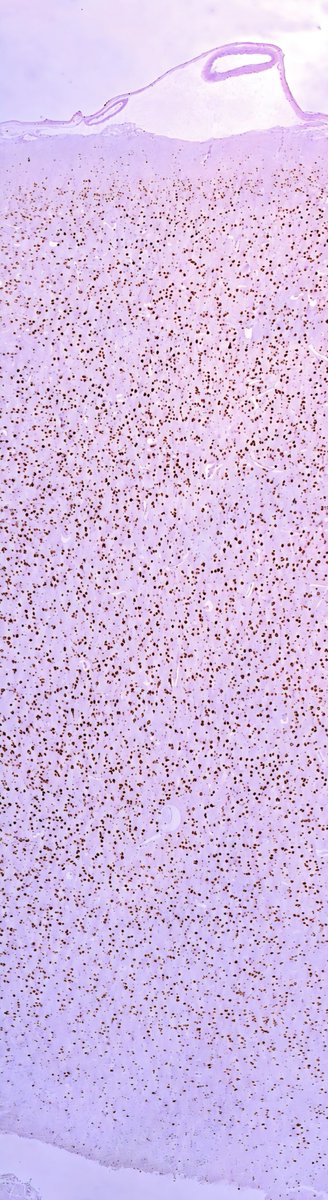 solcosao's tweet photo. Focal cortical dysplasia type Ib in a 4-year-old boy with longstanding, drug-resistant epilepsy. NeuN immunostaining. #Neuropathology https://t.co/ImPjmpV88T