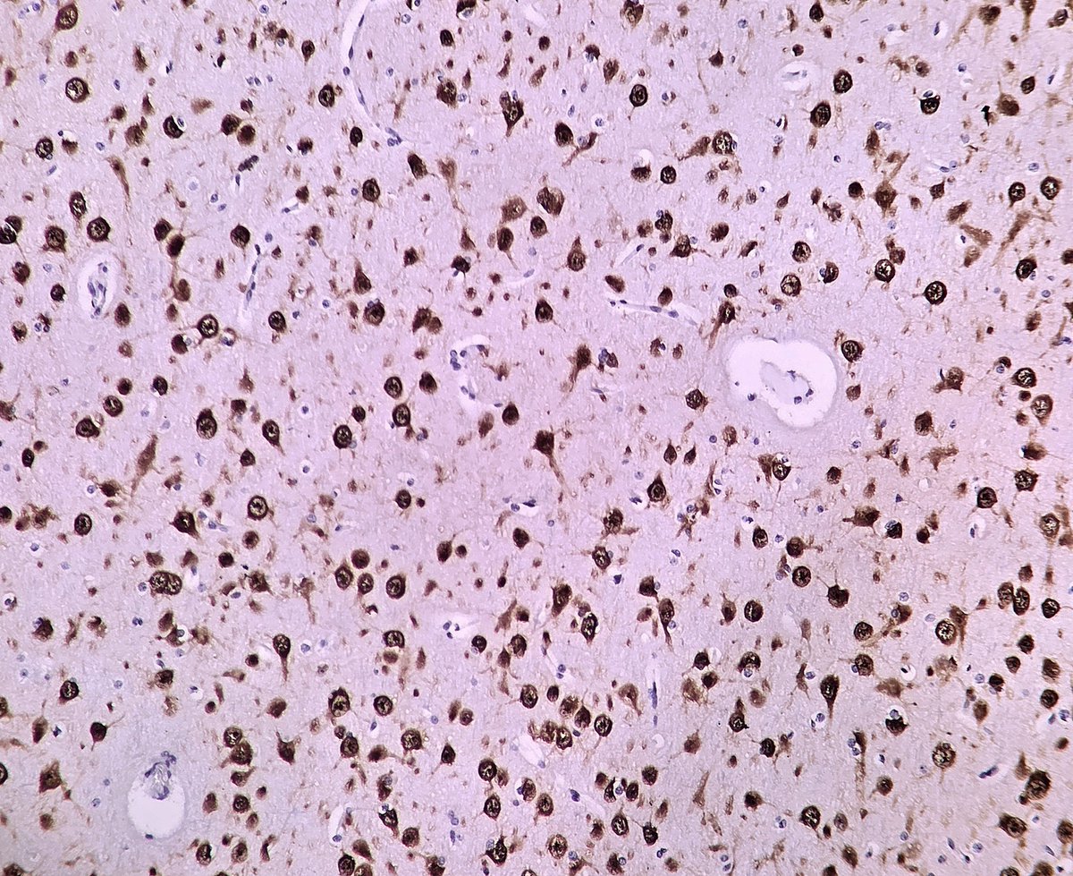 solcosao's tweet photo. Focal cortical dysplasia type Ib in a 4-year-old boy with longstanding, drug-resistant epilepsy. NeuN immunostaining. #Neuropathology https://t.co/ImPjmpV88T