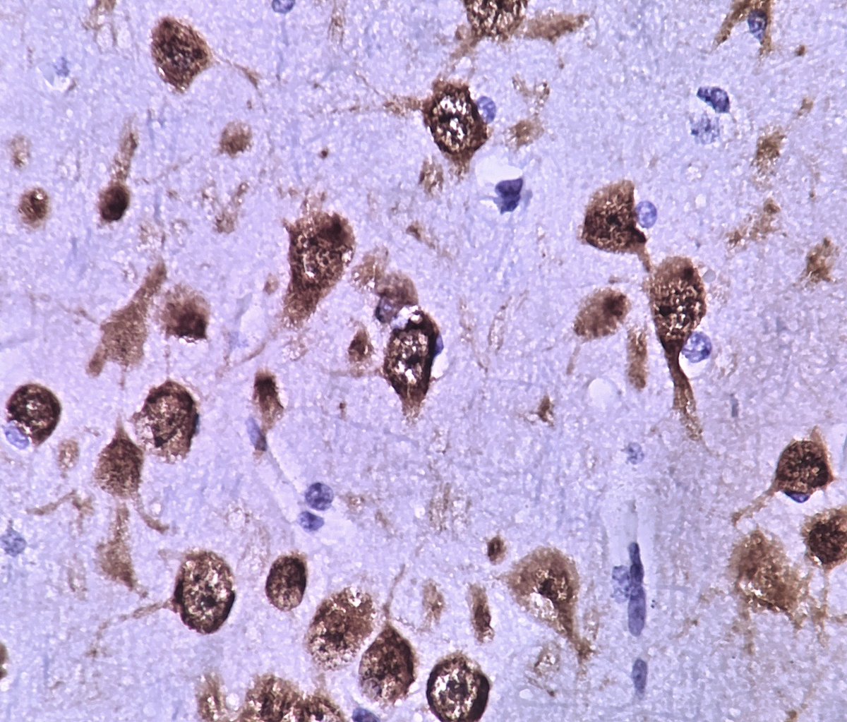 solcosao's tweet photo. Focal cortical dysplasia type Ib in a 4-year-old boy with longstanding, drug-resistant epilepsy. NeuN immunostaining. #Neuropathology https://t.co/ImPjmpV88T