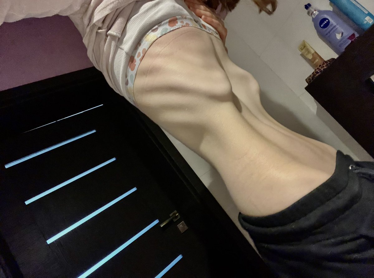 dulcorexia's tweet photo. i got sick :( and i feel so bloated and huge is it normal to feel like this omg i h8 it https://t.co/JhK0HdScDw