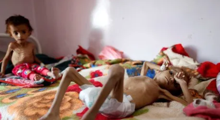 LucasGageX's tweet photo. Look what Zionists have done to these Gazan kids.

Actually, they're Yemeni kids starving because Saudi Arabia and Iran-backed Houthis blocked aid to feed them. Over 85k under 5 have died.

You don't hear about it because Muslim lives only matter when the US or Israel takes them. https://t.co/3Hy5nPy1fJ