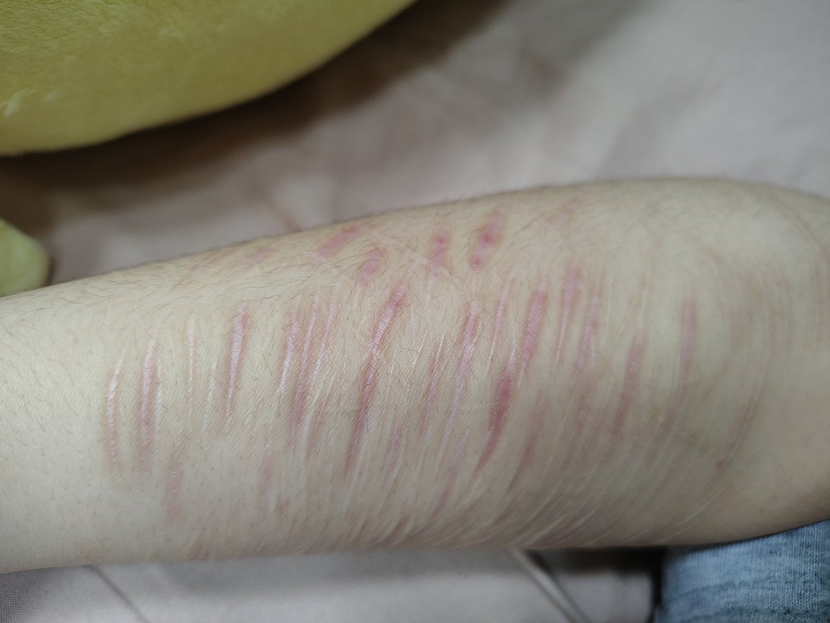 Giallo836's tweet photo. Cuando las veo ni me puedo creer que la mayoría de esas cicatrices fueron alguna vez beans... 😭
¿Será que las cuidé bien? Ay no se... 
⚠️¡Precaución!⚠️
-
-
-
-
-
-
-
-
-
-
#sh #cicatrices https://t.co/z1WbBXcHEu