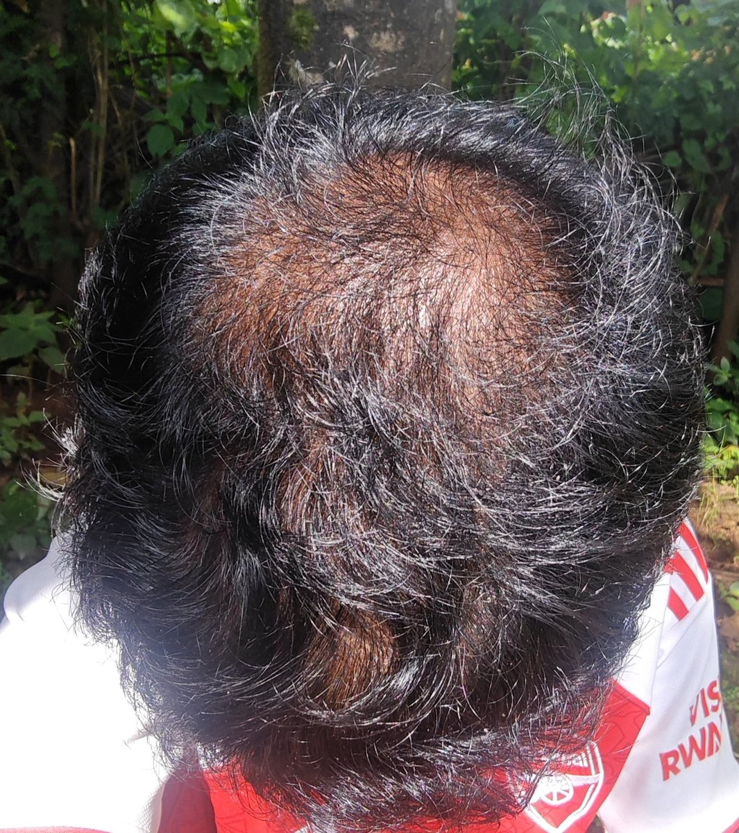 Bald1u's tweet photo. 20 years old 

Trader 
dream not complete but hair complete😓 
@NQTimmy https://t.co/BhWXIRVahJ