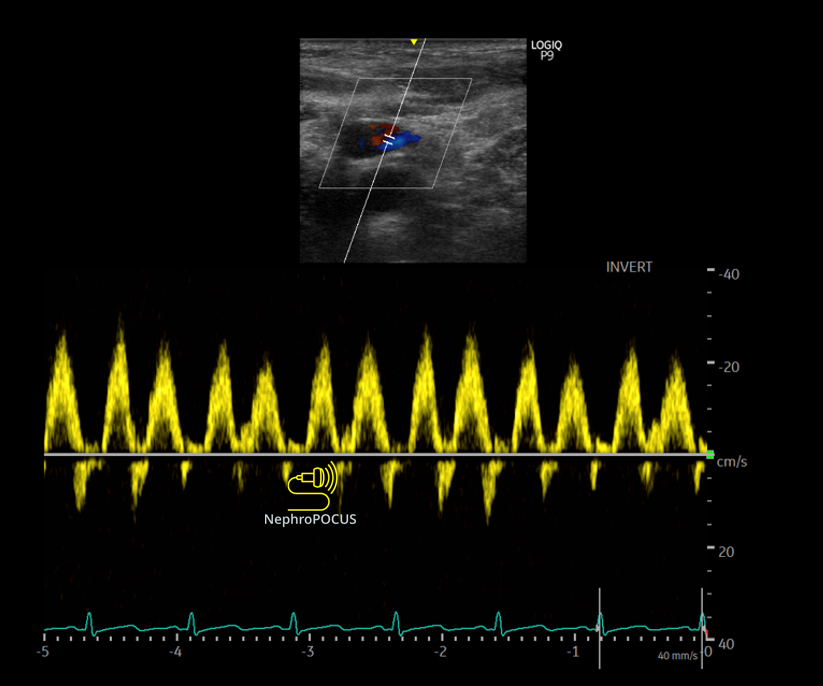NephroP's tweet photo. Easy quiz today
Artery or vein? Why? (neck)
#POCUS #VExUS #Nephpearls https://t.co/r4shrWp6bB