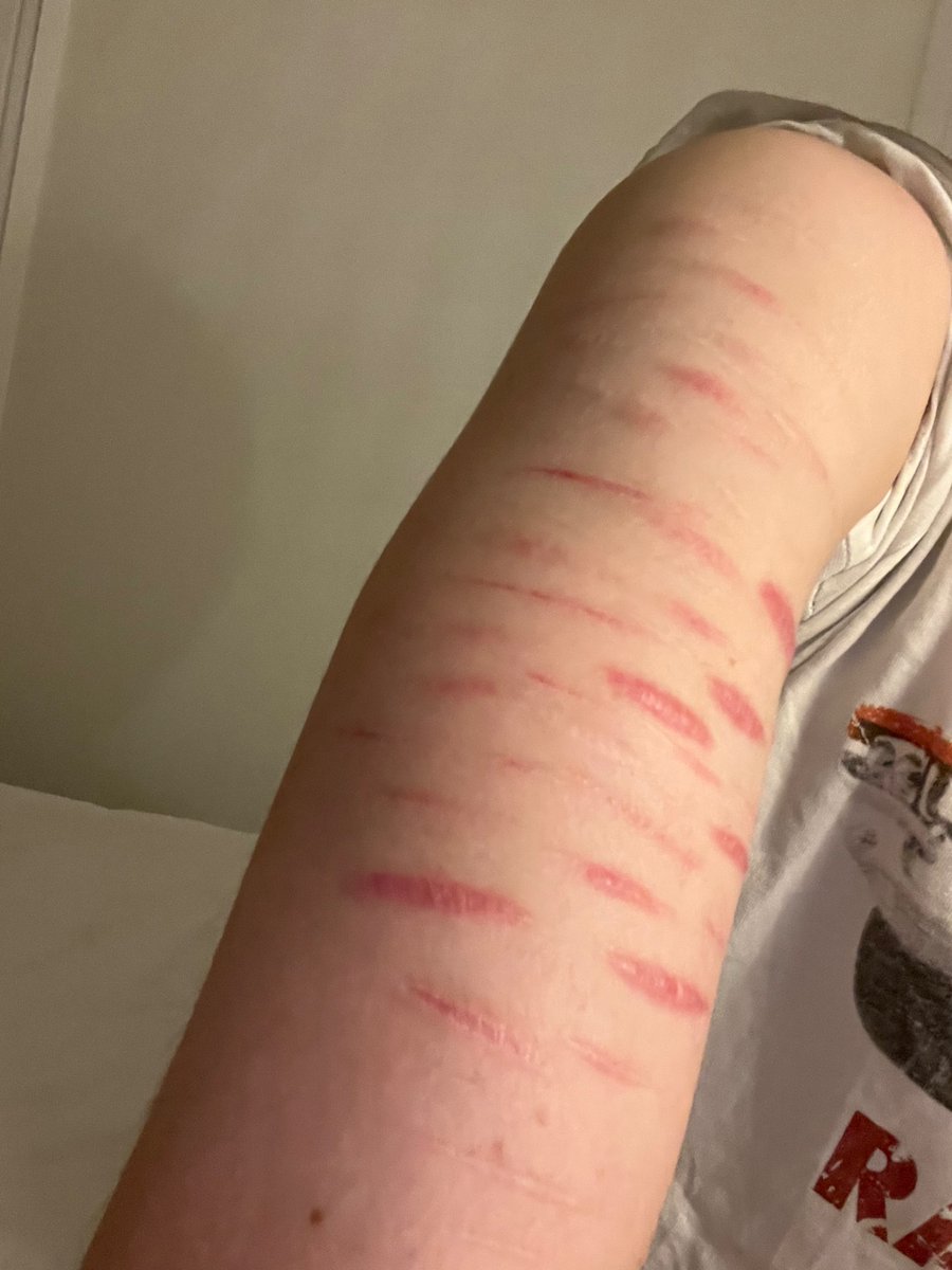 Mybigaaahballs's tweet photo. Scar check. I need more on my lower arms they look so empty (winter is my saviour) #slitwt #shtwt #scars #scarspo ? https://t.co/WDV3pDlp8f