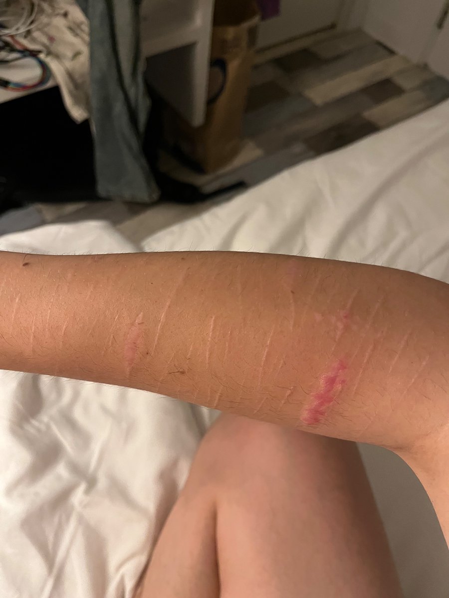 Mybigaaahballs's tweet photo. Scar check. I need more on my lower arms they look so empty (winter is my saviour) #slitwt #shtwt #scars #scarspo ? https://t.co/WDV3pDlp8f