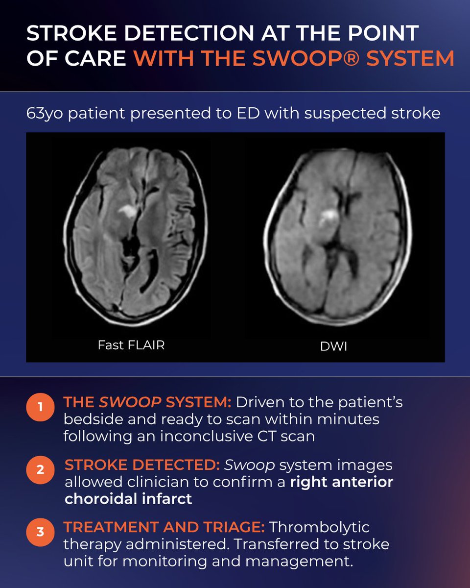 Hyperfine's tweet photo. When #stroke is suspected, timely imaging can help guide critical care decisions. In this case, a 63-year old patient presented to the ED with suspected stroke. The Swoop® system was driven to the patient's bedside and ready to scan within minutes following an inconclusive CT scan. The Swoop system images allowed clinicians to confirm a right anterior choroidal infarct. Thrombolytic therapy was administered, and patient was transferred to stroke unit for monitoring and management. If you’re heading to #ACEP26 in Chicago Oct 5-7, let’s discuss the role of portable brain MRI in #emergencycare. Visit Hyperfine Booth 4220
#Hyperfine #PortableMRI #MedTech