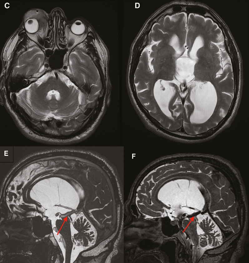 DocNavarrow's tweet photo. 👳‍♂️A 65-year-old man with recurrent conjunctival squamous cell carcinoma presents with gait ataxia, cognitive decline, and urinary and fecal incontinence. No history of head trauma.

🧑‍⚕️What is the underlying cause of his neurological symptoms? https://t.co/YdrwvjvnKq