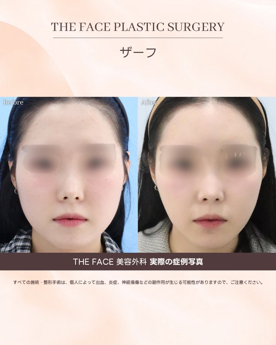 thefacejp's tweet photo. 【 #ザーフ】

フェイスラインのたるみや二重アゴが気になる方へ
お肌の深い層までアプローチし、キュッと引き締まったシャープな輪郭へ⊹ ࣪ ˖

ご予約・お問い合わせは公式LINE
https://t.co/kmBrC3OEwt
 
#韓国美容  #THEFACE美容外科  #垢抜け #渡韓整形 #小顔ケア #二重アゴ #XERF https://t.co/Npc953raRj