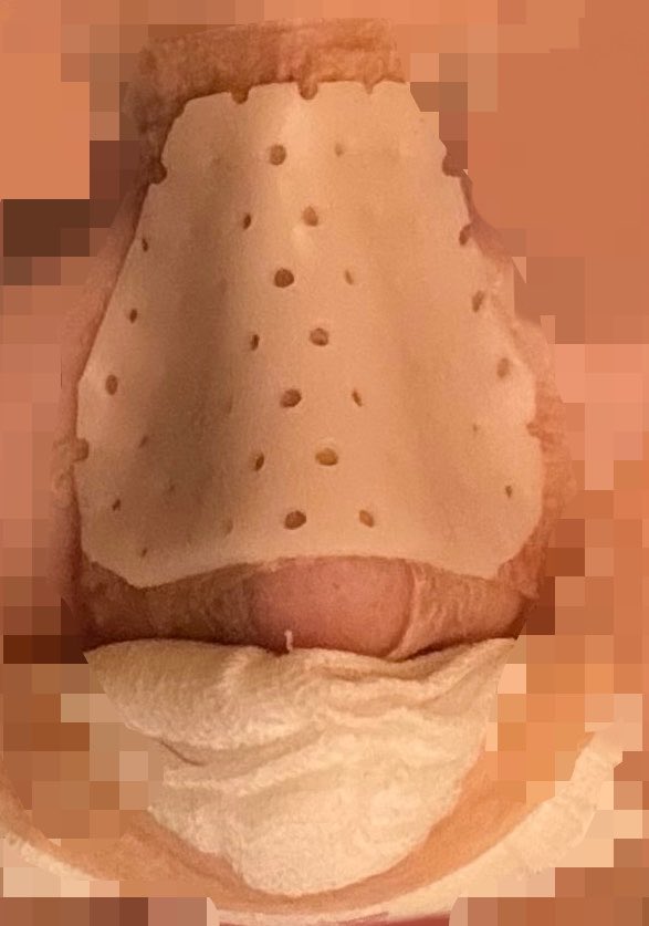jaxqorl's tweet photo. 鼻フル対あり👊ホテル戻った！骨切りもしてるのに全然痛く無くて執刀医の腕？それともそういうもん？次の日から痛み始めるのかな？
 #鼻整形  #鼻フル https://t.co/MyEaurWcJI