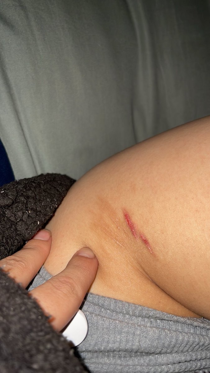 S420pm's tweet photo. I wanna add more but I’ll get in big trouble. I’m so jealous of people’s pretty puffy scars. I’m so pathetic. At least it’s a little puffy? Just tell me I’m right. Twt this is all fake sfx makeup #sh #Scarspo https://t.co/3aVT1vmQFu