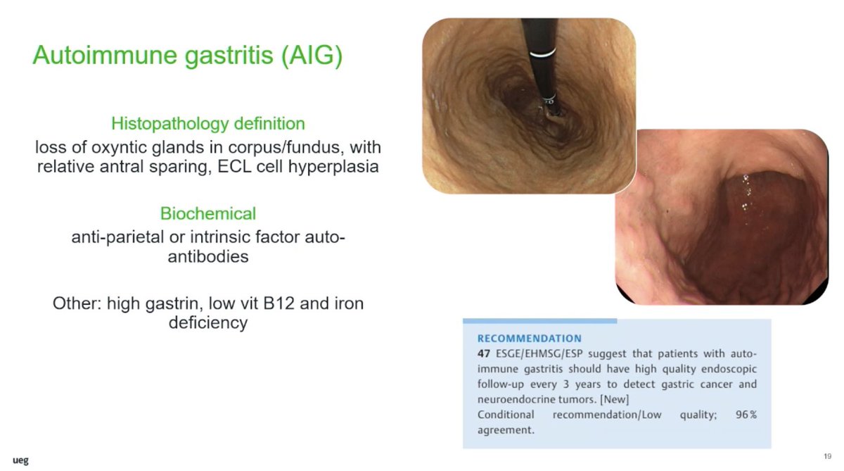 drkeithsiau's tweet photo. Gastric intestinal metaplasia (GIM) - pearls from #UEGWeek 💡

1. Differentiate autoimmune vs H pylori and biopsy using Sydney protocol
2. Risk stratify based on MAPS3 guidelines
3. Use OLGIM staging for extent
4. For autoimmune gastritis, consider immunology, biochemistry and 3 yearly surveillance