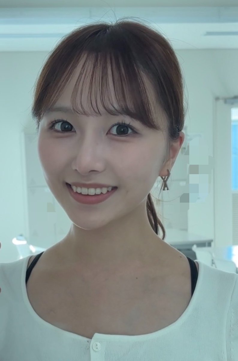 ki__corori's tweet photo. 過蓋咬合を矯正で治したけど(+鼻フル 輪郭脂肪吸引してるから分かりにくいけど)人中はやや伸びて下顔面伸びた感じがする。
人中短くて下顔面短くて潰れたハンバーガー🍔みたいに丸顔の人はやっても良いのかも https://t.co/KpD3kdQYH5