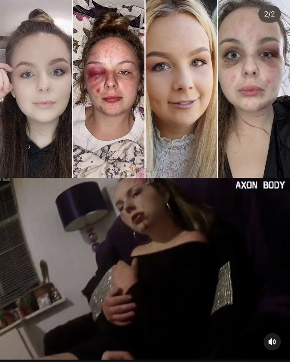Cr7Godbrand's tweet photo. This is the case that made me become RED-PILL.

This is how EVIL a woman can be when she wants attention.

In 2020, Eleanor Williams in England posted on Facebook that she was raped, beaten, and trafficked by a group of Asian men. She posted pictures of her "injuries" and went VIRAL.

Everyone believed her instantly. No proof needed. Feminists lost their minds, attacked all men, protested in the streets, "believe all women" everywhere. The whole country was in outrage.

And innocent men’s lives were DESTROYED. Men were threatened, harassed, called rapists and traffickers. Their families were targeted. All because of a LIE.

Then police actually did their job and checked the CCTV, the phone records, the evidence. 

Everything contradicted her story. She faked it ALL. Fake bruises from a hammer she bought herself, fake messages, fake stories, fake injuries. Pure fiction for attention.

In March 2023 she was finally sentenced to 8 years and 6 months for perverting the course of justice.

8 years for ruining multiple innocent men's lives with a lie.

This is modern women. Lie, get famous, destroy men, play victim, and the whole world claps for you until the truth comes out.

Believe all women? No. Believe EVIDENCE.