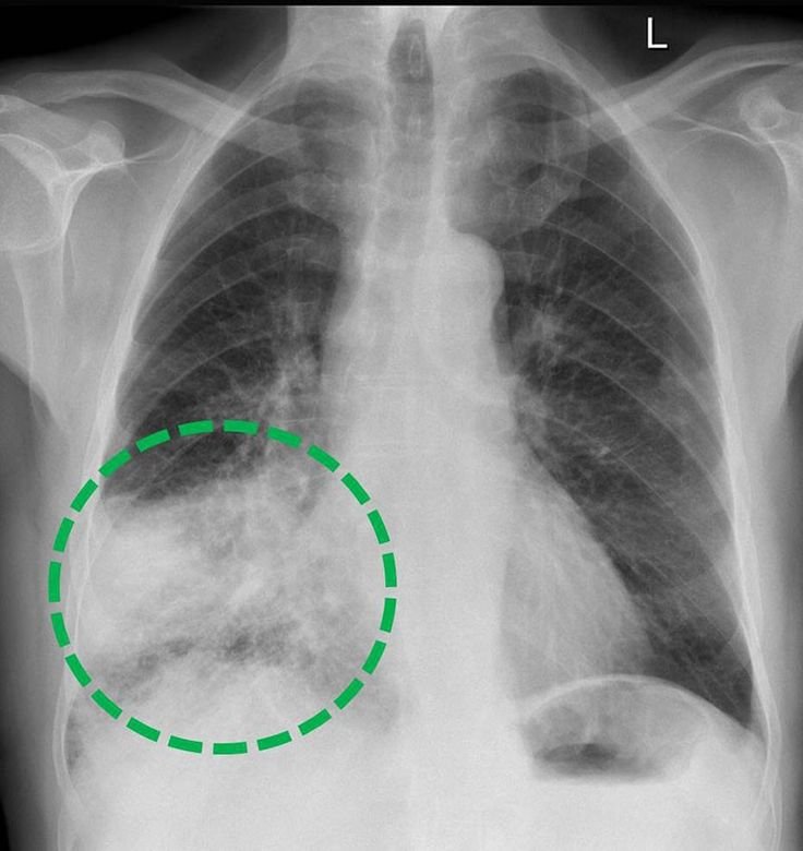 Chrisvance_md's tweet photo. I cured a patient with stage 4 Breast  cancer  using a personalized protocol.
This regimen include:
IVERMECTIN __ 48 mg for 3 days on 4 days off
Mebendazole _1800 mg
FENBENDAZOLE (444 mg)
DMSO 
CBD oil
Vitamin E
#Europe #joeroganhq #cancercure #Ivermectin https://t.co/E1YXdAxQbf