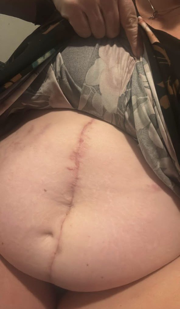 paddyosa's tweet photo. “This is a picture of my surgery scar. It reminds me of what I went through and how strong I had to be during my recovery. It wasn't an easy experience, but I'm doing my best to heal and stay strong. ❤️🙏” https://t.co/8AJPUSqSW2