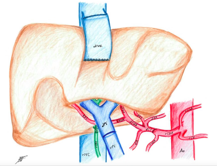 MarcGozlan's tweet photo. Transplanter à l’envers le foie d’un donneur aux organes en miroir.
Un patient a reçu une double greffe foie-rein d’une donneuse atteinte de situs inversus totalis, malformation où tous les organes thoraciques et abdominaux sont inversés.
https://t.co/aceShsYJxF [Rediff] https://t.co/8hGldj08la