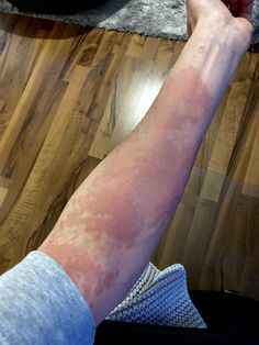 AngelPerezxpx's tweet photo. ¿PUEDES TENER UNA ITS SIN NOTAR NINGÚN SÍNTOMA? 7 INFECCIONES DE TRANSMISIÓN SEXUAL QUE DEBES CONOCER.

1. VIRUS DEL PAPILOMA HUMANO (VPH) https://t.co/hs11tYy5BL