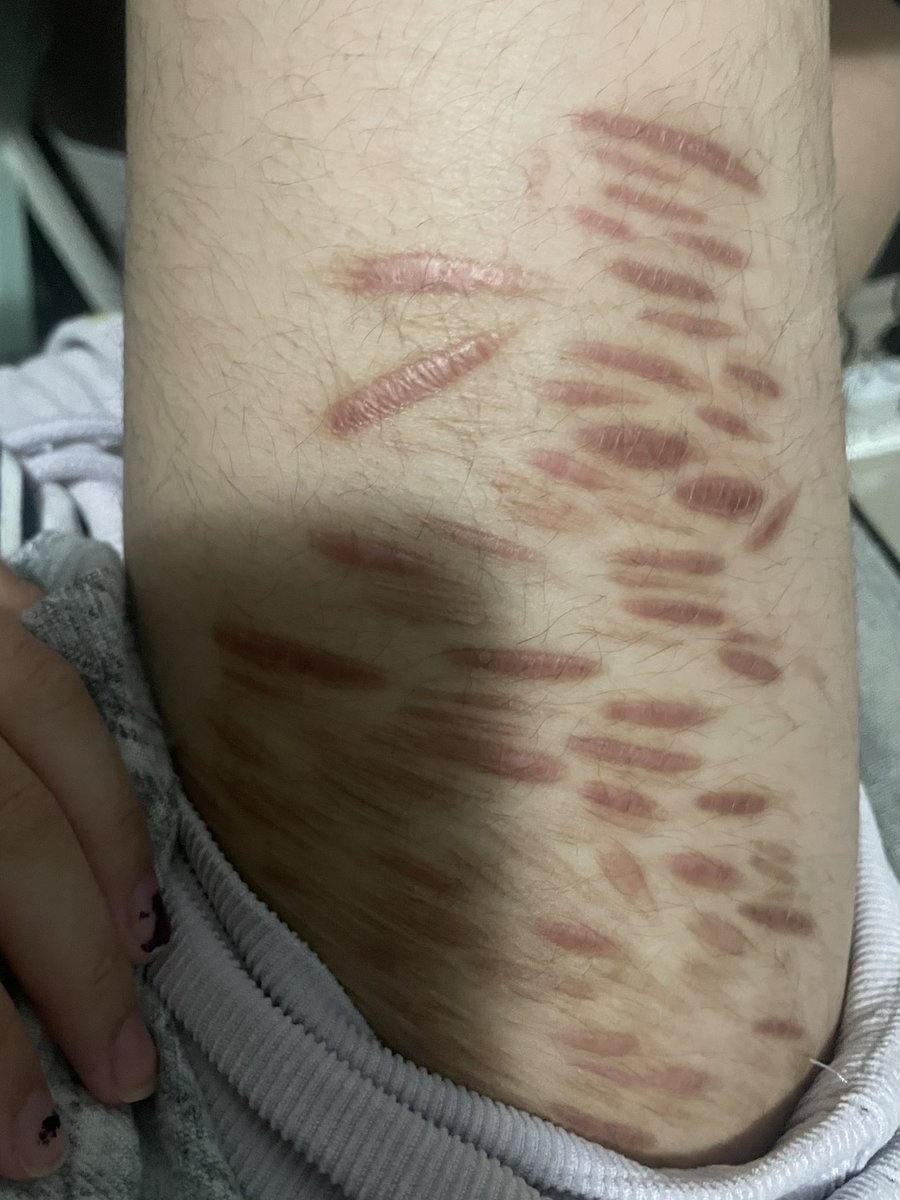 cal4wst's tweet photo. Haven’t  posted here in awhile, scar check I guess. Am I scarspo guys……. https://t.co/kGxTB5ge5A