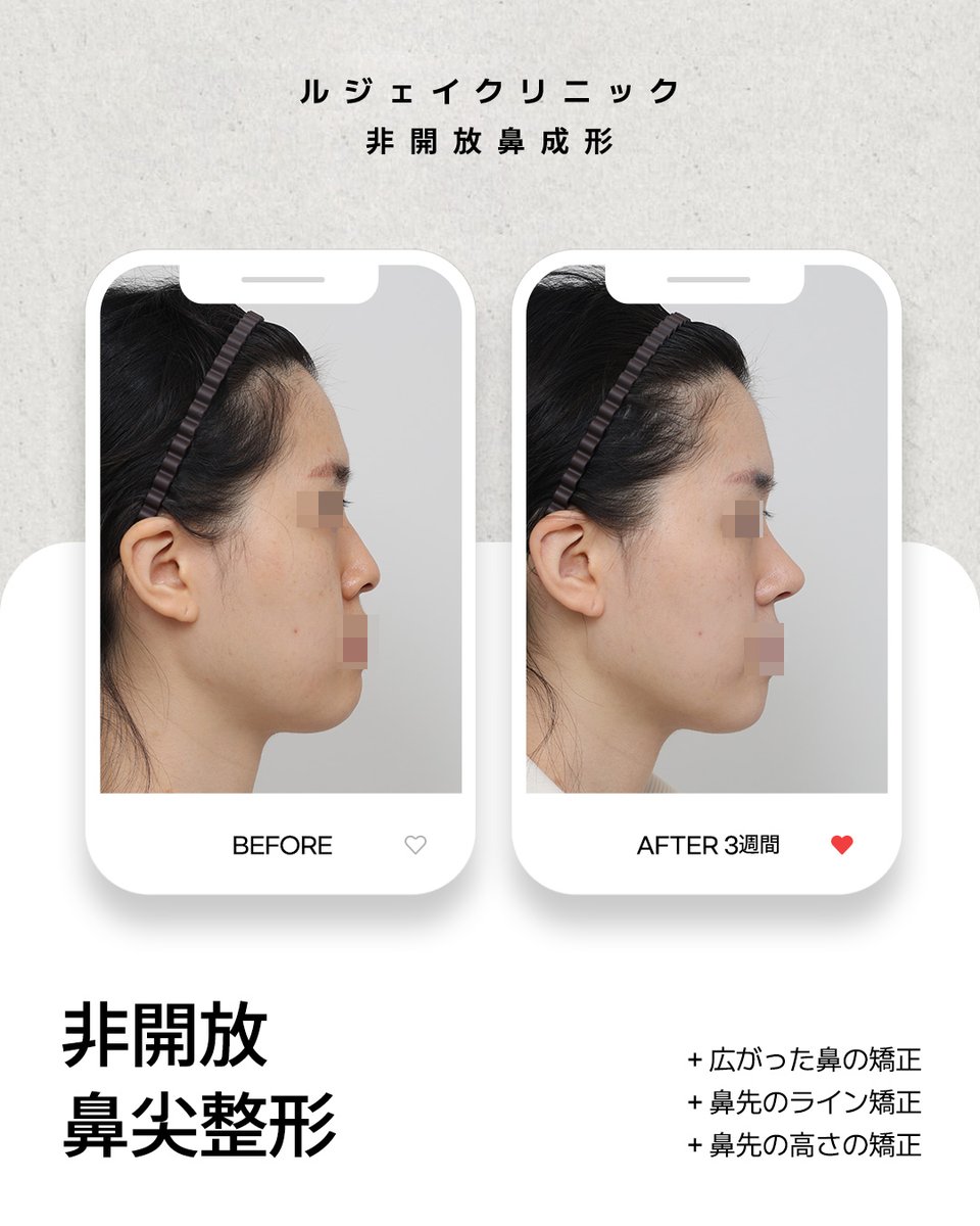 lejclinic's tweet photo. 鼻先のディテールが���み出す印象の違い 👃🏻
ルジェイクリニックのクローズ法による鼻尖形成は、鼻の下の皮膚を外側から切開せず、鼻の内側からアプローチし、鼻先の軟骨の形状や位置、鼻柱のラインと鼻唇角のバランスまで考慮してデザインしています。#韓国鼻整形 #アイドル鼻整形 #鼻整形 https://t.co/HWnME0rUdM