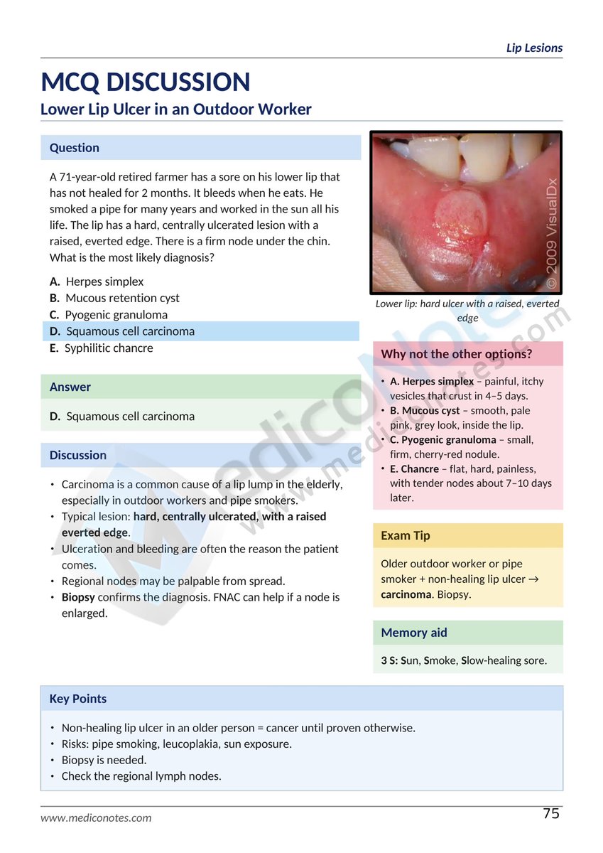 MedicoNotes's tweet photo. 🩺 MEDICAL MCQ: NON-HEALING LOWER LIP ULCER

A 71-year-old retired farmer presents with a lower lip ulcer that has persisted for 2 months and bleeds when eating.

Remember the 3 S’s:
☀️ Sun exposure
🚬 Smoke exposure
🐌 Slow-healing sore

🌐 https://t.co/T7sIXlE7x6 https://t.co/Ikza8zWX8D