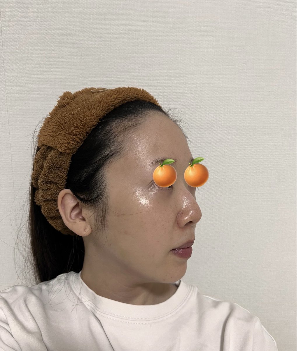 nononpyon's tweet photo. 裏ハムラと脂肪移植をしていただ��て1ヶ月が経ちました！
1枚目が術前で、2.3.4枚が術後です😊
LINEの対応も終始丁寧かつスピーディーで、先生も通訳さんもすごく親切な病院でオススメです😊
＃エンド整形外科
@and_ps_eye @and_ps_jp https://t.co/FCALiryz2N