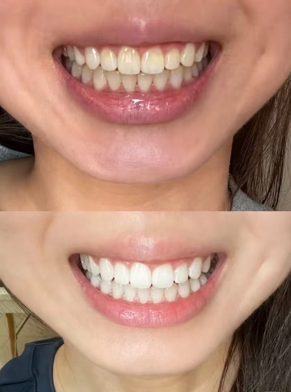 azaelovein's tweet photo. GIGI KUNING TUH JOROK 😭 sumpah pake ini 3 hari langsung cerah! https://t.co/cq7izjkqlk