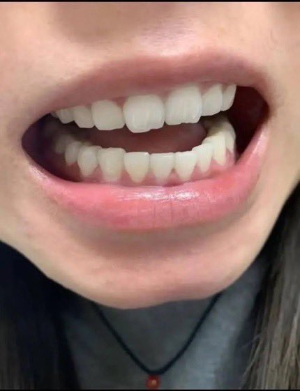 venggk's tweet photo. Saran dokter: ganti pasta gigi dengan Hydroxylapatite.
Hasilnya: plak ogah nempel, karang gigi memudar, napas lebih segar.
Ternyata sesederhana itu. 🥹 https://t.co/11ANXxwmwW