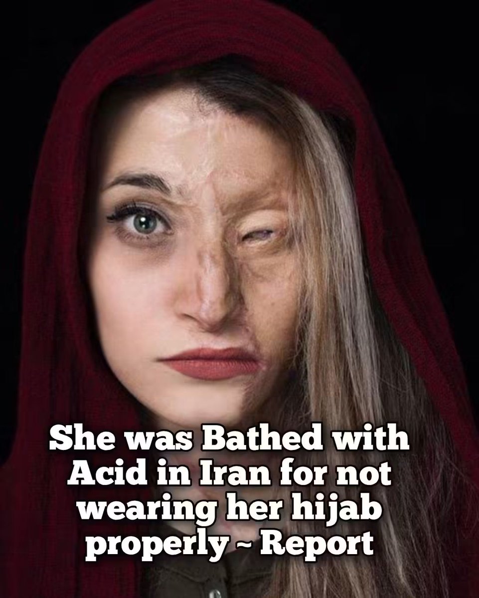 Ellis5ol's tweet photo. She was Bathed with Acid in Iran for not wearing her hijab https://t.co/owNdwejOwL