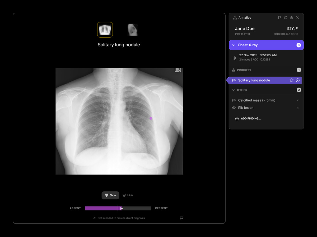 Kennyperez's tweet photo. Royal Surrey NHS says a woman went from a GP visit for a persistent cough to a lung cancer diagnosis in 48 hours after https://t.co/3g3HoypD6M flagged her chest X-ray — caught at Stage 1. The AI now prioritizes urgent chest X-rays across five NHS trusts. @annalise_ai https://t.co/ZlIF8fvQnT