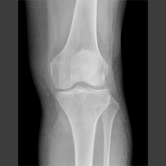 RadMasterclass's tweet photo. X-RAY QUIZ: AP and Lateral. Direct trauma to the lateral side of the knee. Is there a visible injury? If so, what is the injury? Start Quiz https://t.co/80z4288Msz https://t.co/dapCDBvEf4