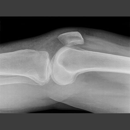 RadMasterclass's tweet photo. X-RAY QUIZ: AP and Lateral. Direct trauma to the lateral side of the knee. Is there a visible injury? If so, what is the injury? Start Quiz https://t.co/80z4288Msz https://t.co/dapCDBvEf4