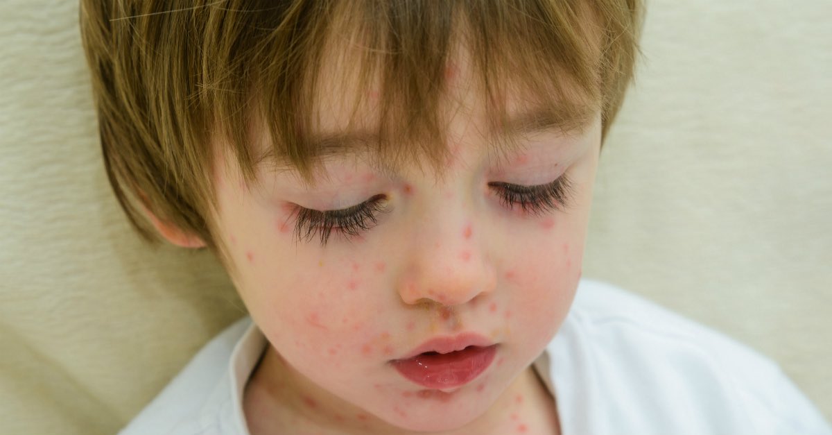25YearsAgoLive's tweet photo. Numerous parents in Pittsburgh, Pennsylvania are under investigation after hosting “chicken pox parties” for their kids, in which one child who has chicken pox is ordered to mingle with others, so as to infect them all and give lifetime immunity. https://t.co/PIE8zdv74q