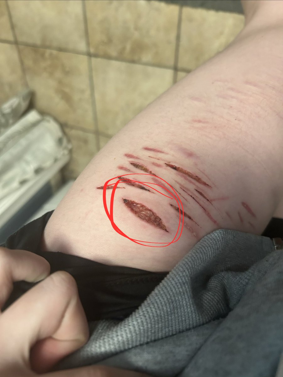 Snowflaketxtt's tweet photo. It’s kinda hot to the touch but idk if it’s infected or not, it was a beans cut so I’m just making sure🥹🫰 https://t.co/rtae8D5Ole
