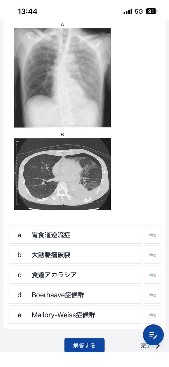 medicalhackerm's tweet photo. 答え気胸じゃないの❓ https://t.co/pOFCg2LBzG