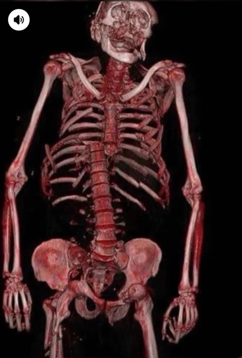 _OWARS_'s tweet photo. @sonic790073 Cómo describes tu escoliosis ahhh type shit ✌🏻😭 https://t.co/8bi99XjKP0