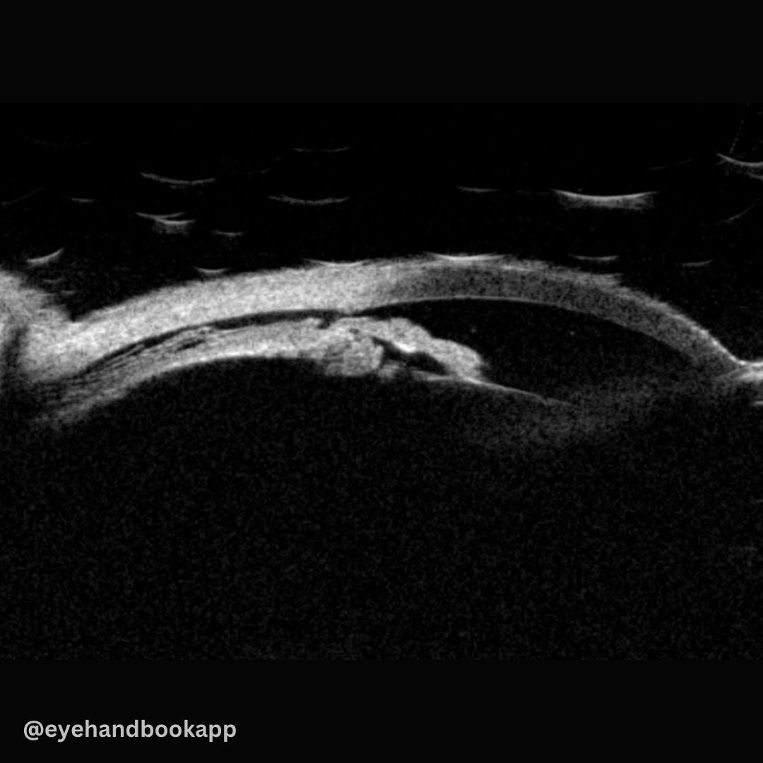 EyeHandbook's tweet photo. What do you see here? | Eye Handbook App for Eye Care Professionals | Check ALT (image description) for more
#eyes #cornea #eyetrauma #ocular #oculartrauma #oftalmologia #eyecare #eyesight #eyehealth #ophthalmology #optometry #ophthalmologyresidents #optometryresidents https://t.co/h7v6RZEjrC