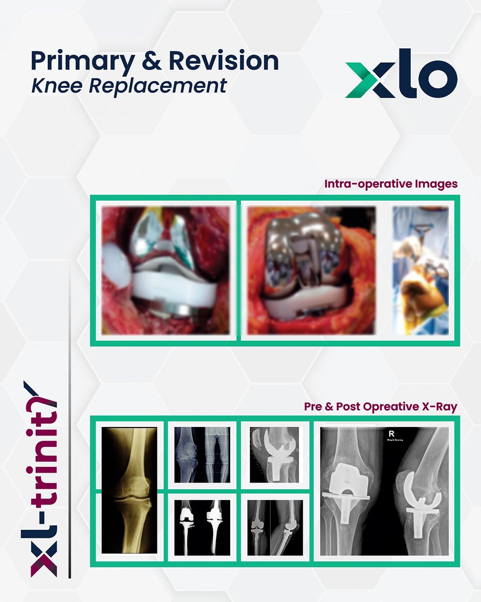 xlortho's tweet photo. Complex Revision. Refined Precision.
The XL-Trinity Revision Knee System is engineered for consistent resection, enhanced stability, and precision in complex revision knee procedures.
Stable by Design. Precise by Engineering.
#XLTrinity #RevisionKnee #KneeReplacement #Revision https://t.co/R45KRk86yl